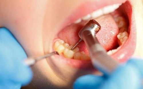 智齿发黑坏了需要治疗吗？不痛的智齿还需要拔吗？