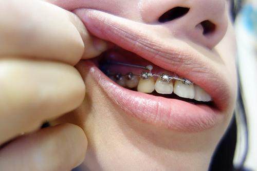 为什么正畸复诊时间间隔不一致？如何缓解正畸期间的口腔不适？