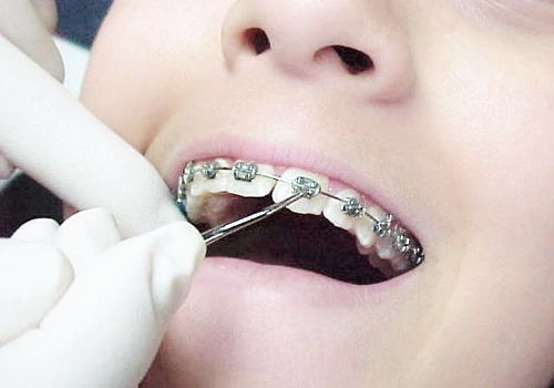 正畸小知识：正畸治疗结束后口腔不适的症状会自然消失吗？