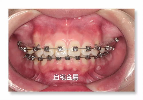 骨钉的作用是什么？牙齿矫正为什么要打骨钉？