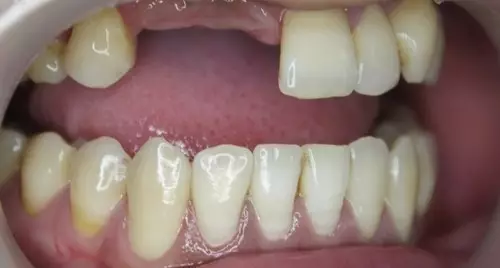 牙齿缺失不治疗会有哪些后果？牙齿缺失可以避免吗？