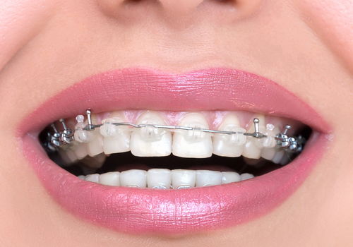 矫正牙齿哪种材质好？牙齿错位可以做牙齿矫正吗？