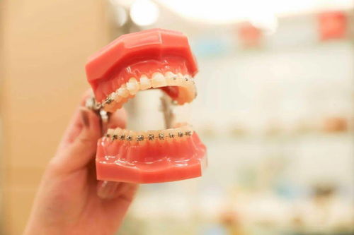 正畸科普：哪些因素会影响陶瓷牙套的矫正效果？