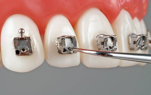 矫正牙齿的钢丝有什么作用？牙齿矫正的钢丝会戳嘴吗？