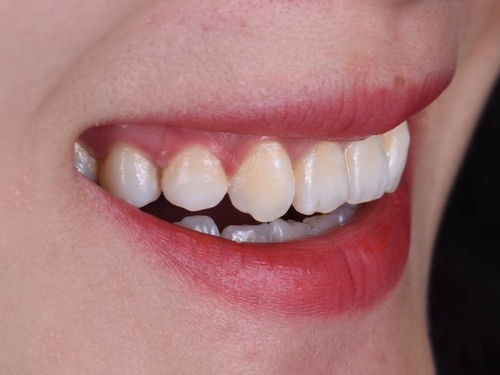 牙科小知识：除了牙齿矫正还有哪些方法可以改善牙槽骨突出？