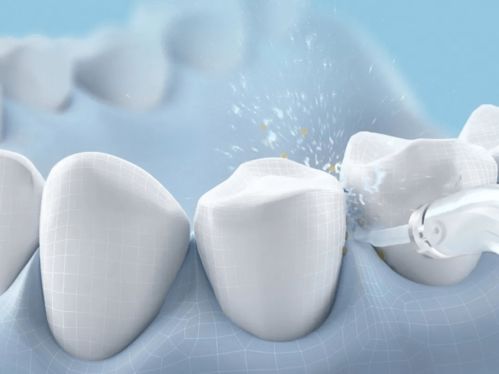 牙科小知识：烤瓷牙松动后可以采取哪些临时处理措施？