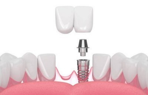 种牙小知识：种植体周围炎的发病原因有哪些？
