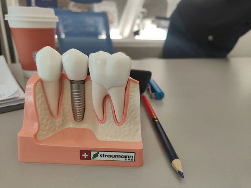 种植牙手术会有隐患吗？种植牙的安全怎么保证？