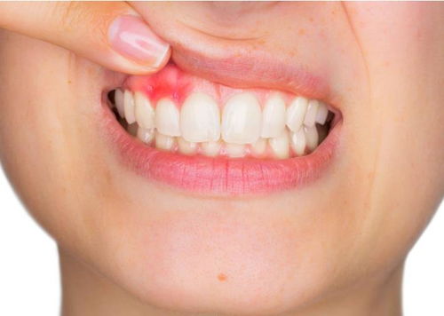 牙周炎有哪些危害？日常生活中应该如何预防牙周炎？