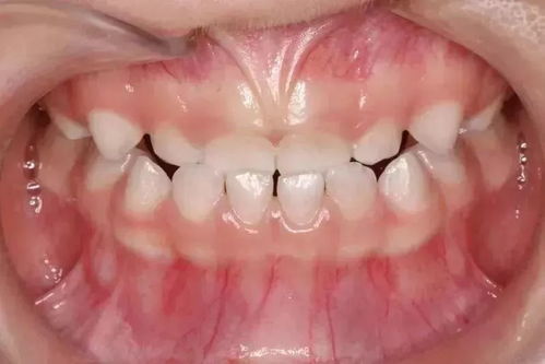 儿童地包天矫正一般在几岁？儿童地包天早期矫正有哪些方法？