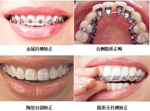 正畸科普：不同的牙齿矫正方式各有什么优缺点？