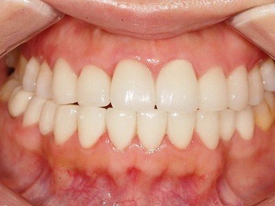 牙科知识：活动假牙和固定假牙的使用寿命分别是多久？