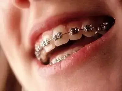 正畸科普：牙齿矫正过程中如何避免副作用的出现？