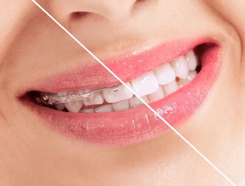 正畸小知识：有哪些方法可以加快成年人牙齿矫正的速度？