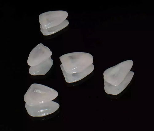 牙齿全瓷贴面需要多久？牙齿全瓷贴面有哪些优缺点？