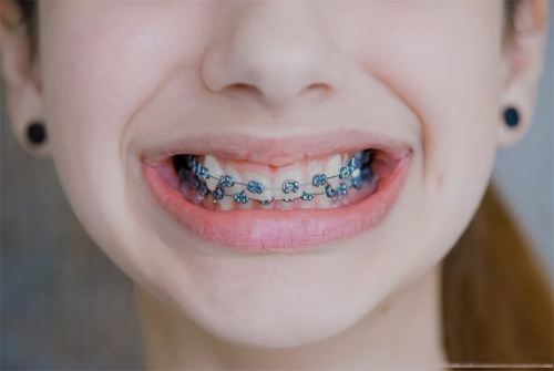早期牙齿矫正干预有哪些方法？早期牙齿矫正后需要注意什么？