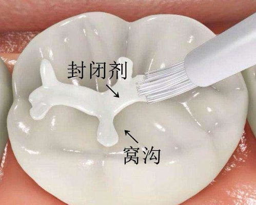 窝沟封闭和补牙有什么区别？儿童和青少年补牙后需要注意什么？