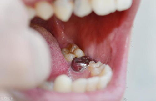 哪些人群更容易患上龋齿？如何判断龋齿的严重程度？