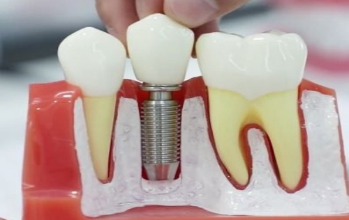 种植牙后多久复查一次？种植牙后多久可以正常饮食？