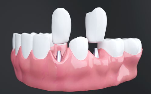 种牙小知识：种植牙后如何预防牙龈发黑？