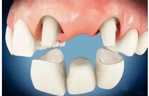牙科知识：全瓷牙冠和烤瓷牙冠的优缺点对比？