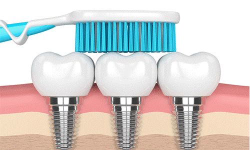 种植牙后多久可以刷牙？种植牙期间可以喝酒吗？