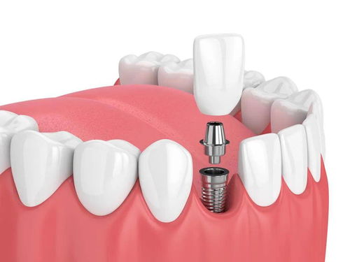 做种植牙用不用拔牙根？牙槽骨不好是不是不能种牙？