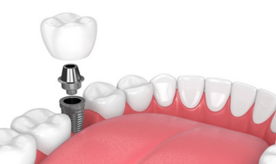 种牙小知识：哪些因素会影响即刻种植的成功率？