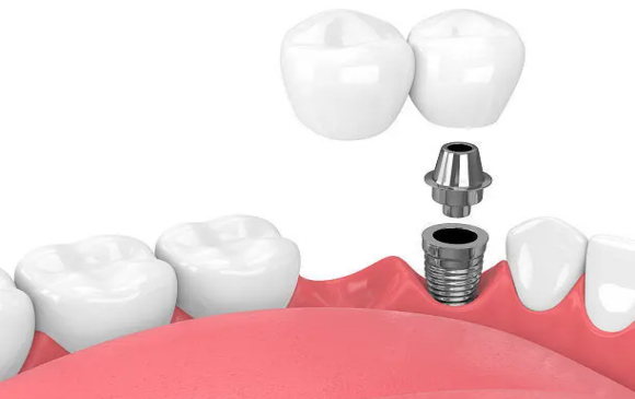 造成种植体脱落的原因有哪些？怎么预防种植体脱落？