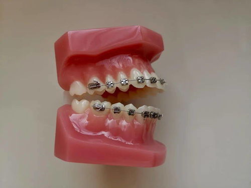 正畸小知识：托槽的矫正效果会受哪些因素影响？