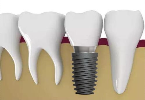 植骨在种植牙中起什么作用？哪些情况适合做种植牙植骨？