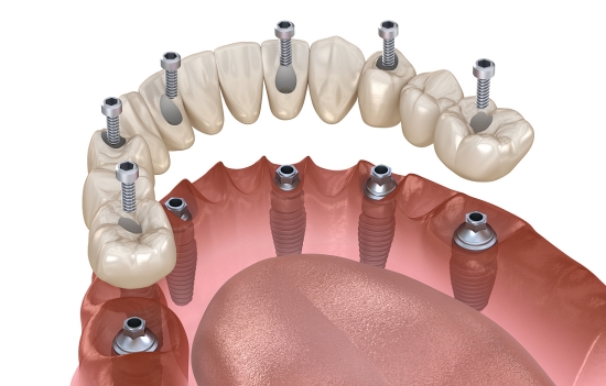 有哪些常见的植骨材料？植骨后需要注意什么？