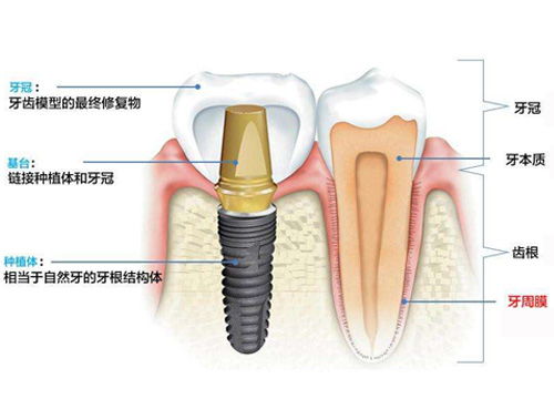 种植体的基台用的是什么材料？要怎么进行选择？