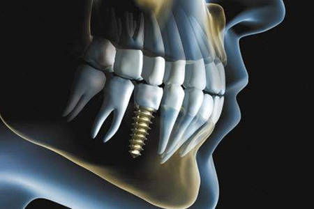 种牙前须知哪些风险？种植牙后要怎么预防可能出现的风险？