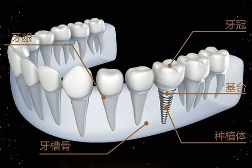 哪些因素会影响种植体的价格？如何选择适合的种植体品牌？