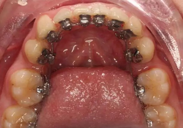 戴牙齿矫正器后是不是更容易得口腔溃疡？口腔溃疡一般多久能自愈？