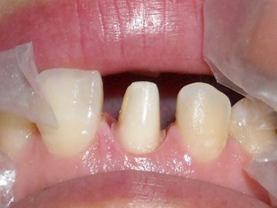 镶牙后怎么保持口腔清洁？镶牙后要注意什么？