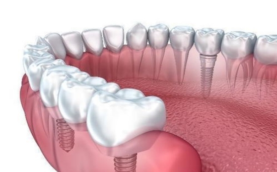 种植体植入前需要做哪些准备？如何缓解种植牙术前的紧张情绪？