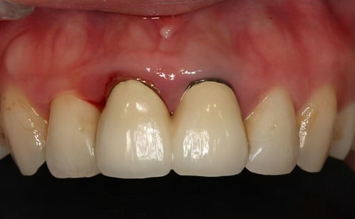 种植牙牙龈发黑后还需要继续维护种植牙？种植牙牙龈发黑要重新种植吗？